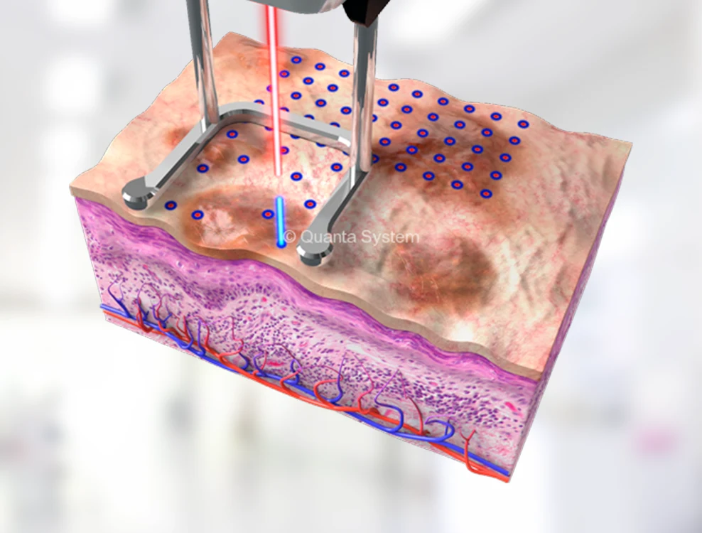 You Laser MT detalhe 2